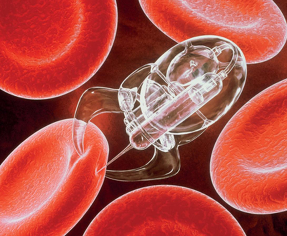 This illustration depicts use of nanorobots to annihilate cancer cells./ Photo courtesy Gregory Carpenter